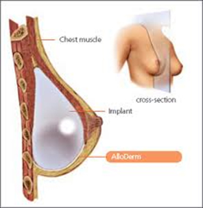 alloderm implant