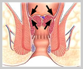 diagnosing pph