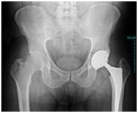 depuy hip