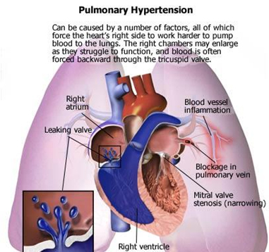 PPH