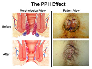 what is pph